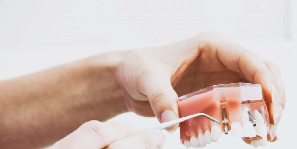 When to Get Dental Implants - 5 Dental Conditions to Look Out for